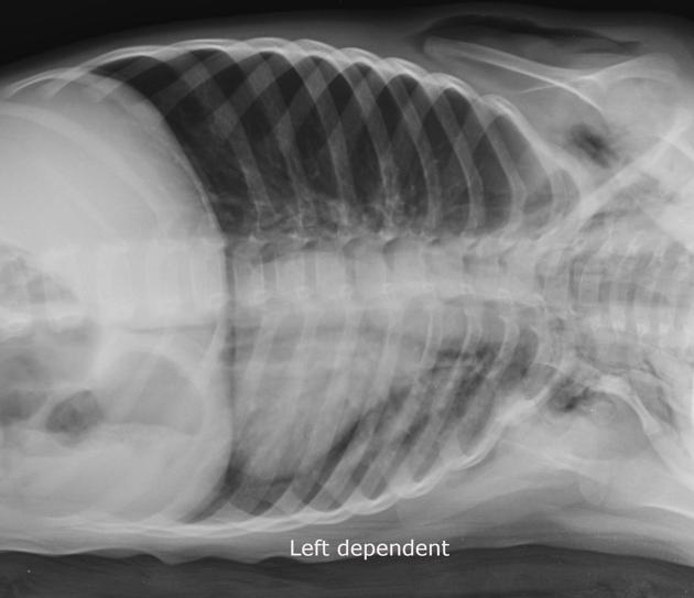 Foreign body inhalation_Table Image 4 Foreign body inhalation_Table Image 4